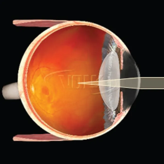 Idrees MidVitreous