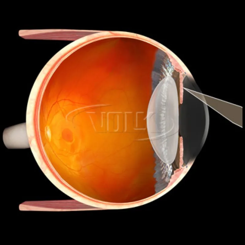 Blumenthal Iridotomy