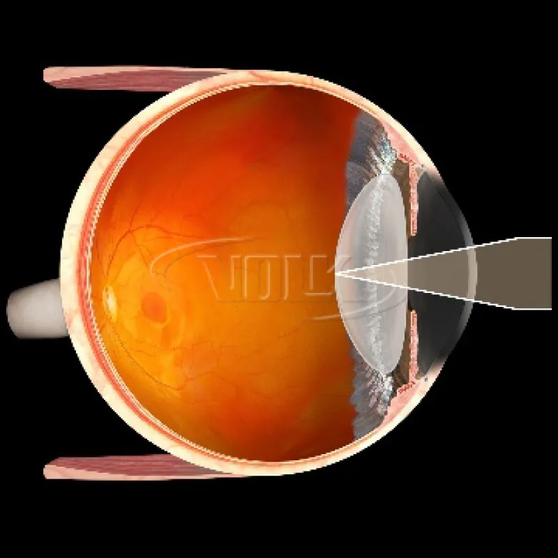 Capsulotomy