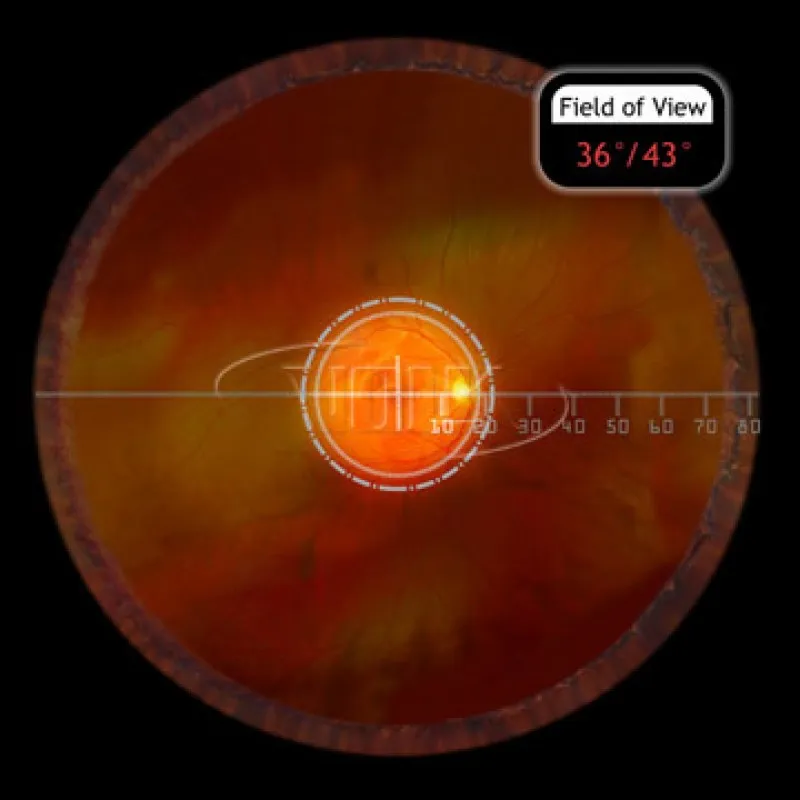 Класична лінза Macula Plus® 5.5